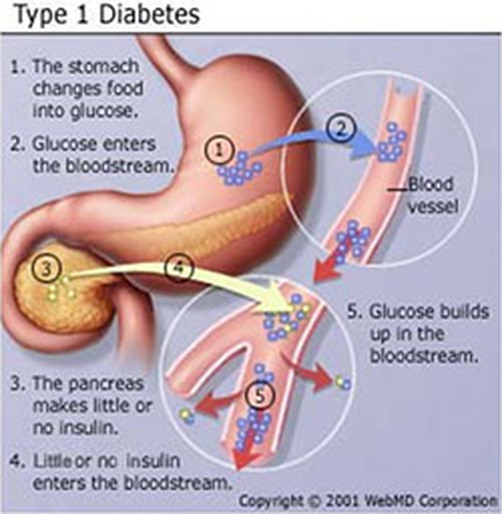 squidoo sudden onset juvenile diabetes